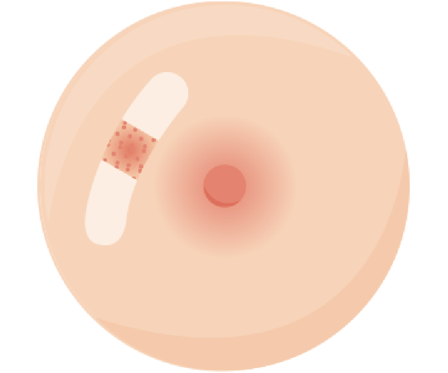 避免乳頭破皮造成乳房產生傷口，能有效預防乳腺炎